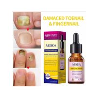 Gotas para tratamiento de uñas con hongos.